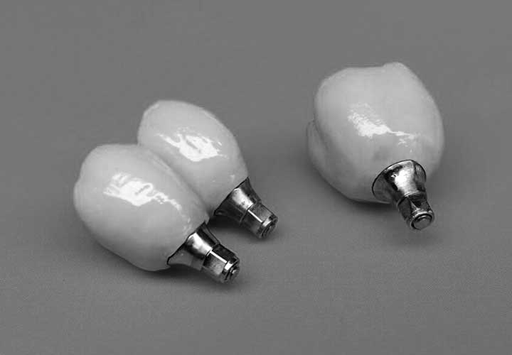 Korony porcelanowe do cementowania na implantach InterActive z łącznikami